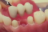 Dental Bridges