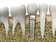 Dental Implants