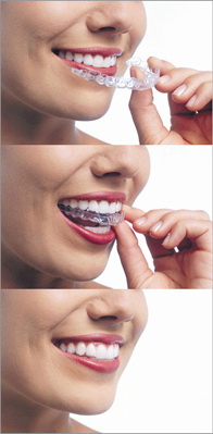 How Your Custom Invisalign Aligners Are Designed