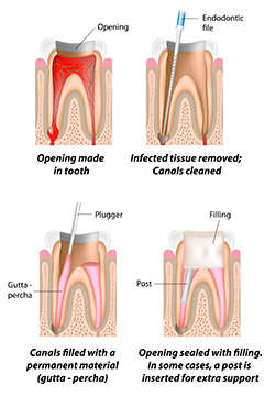 Root Canal Therapy